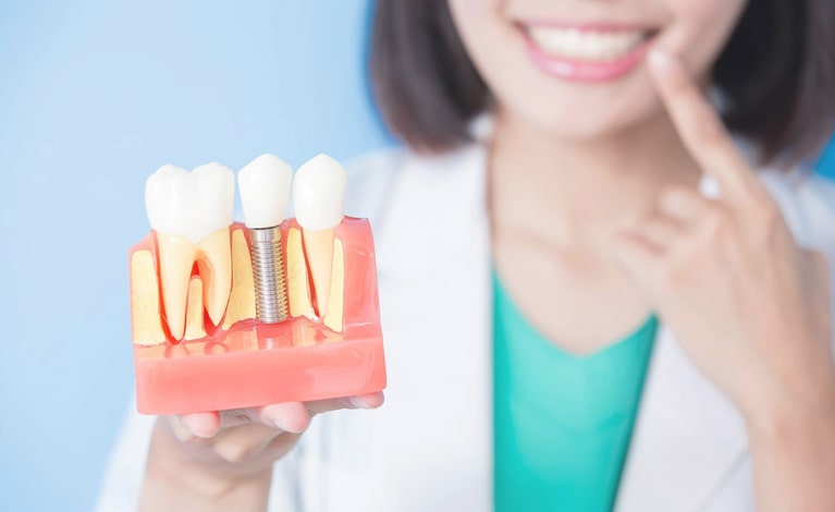 имплантация в стоматологии