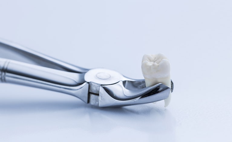 удаление зубов в стоматологии