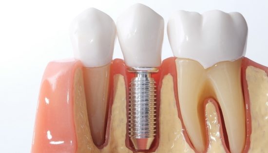 Generic Dental Implant Study Analysis Crown Bridge Demonstration Teeth Model