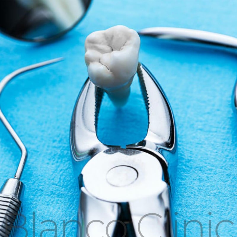 удаление зубов в стоматологии