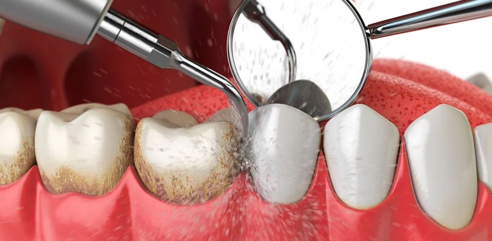 ультразвуковая чистка зубов